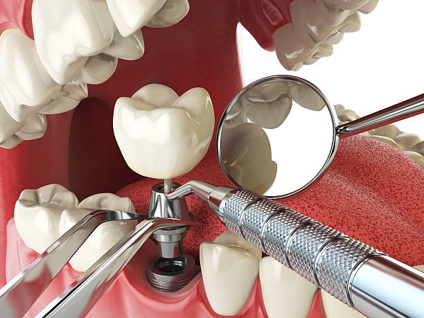 Best Emergency Broken Tooth Repair in Spirit Lake, ID